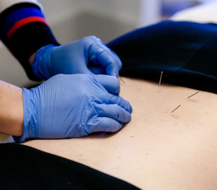 Therapist and patient during a acupuncture appointment in Abbotsford
