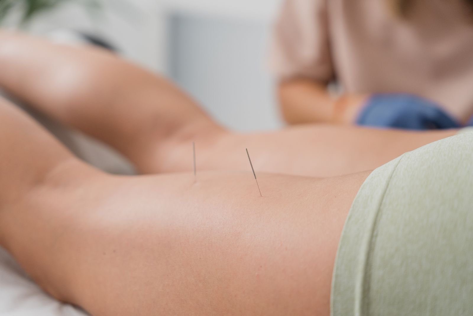 Acupuncture treatment at New Ray Physiotherapy and Health Clinic in Abbotsford