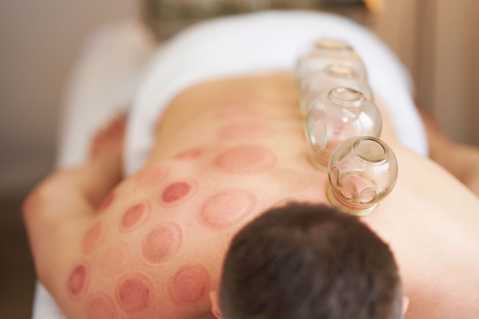 Cupping Therapy at New Ray Physiotherapy and Health Clinic in Abbotsford