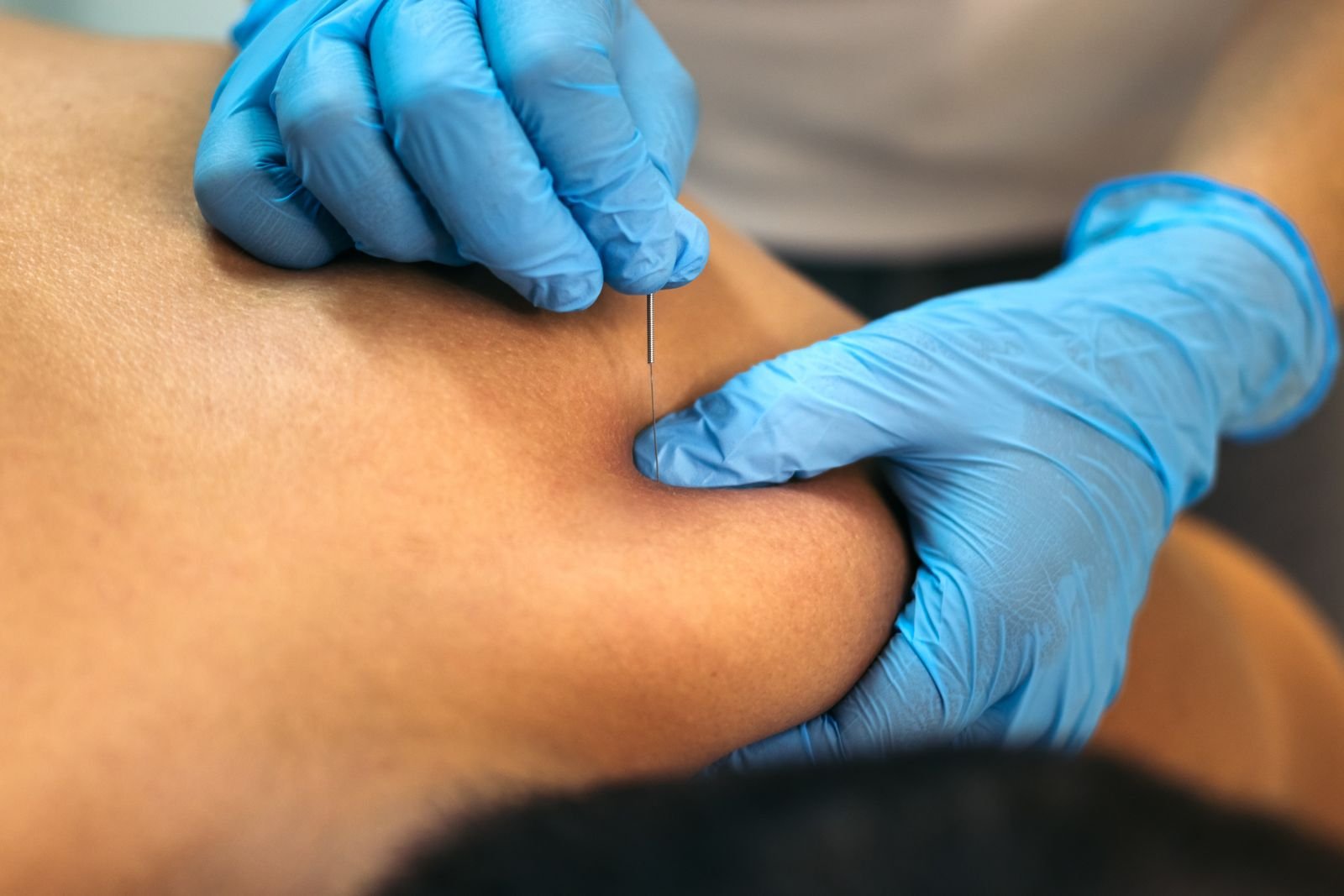 IMS & Dry Needling at New Ray Physiotherapy and Health Clinic in Abbotsford