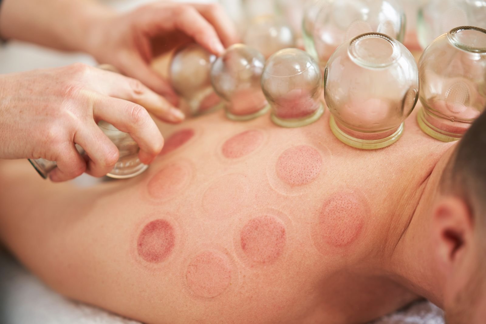 Therapist and patient during a cupping therapy appointment in Abbotsford