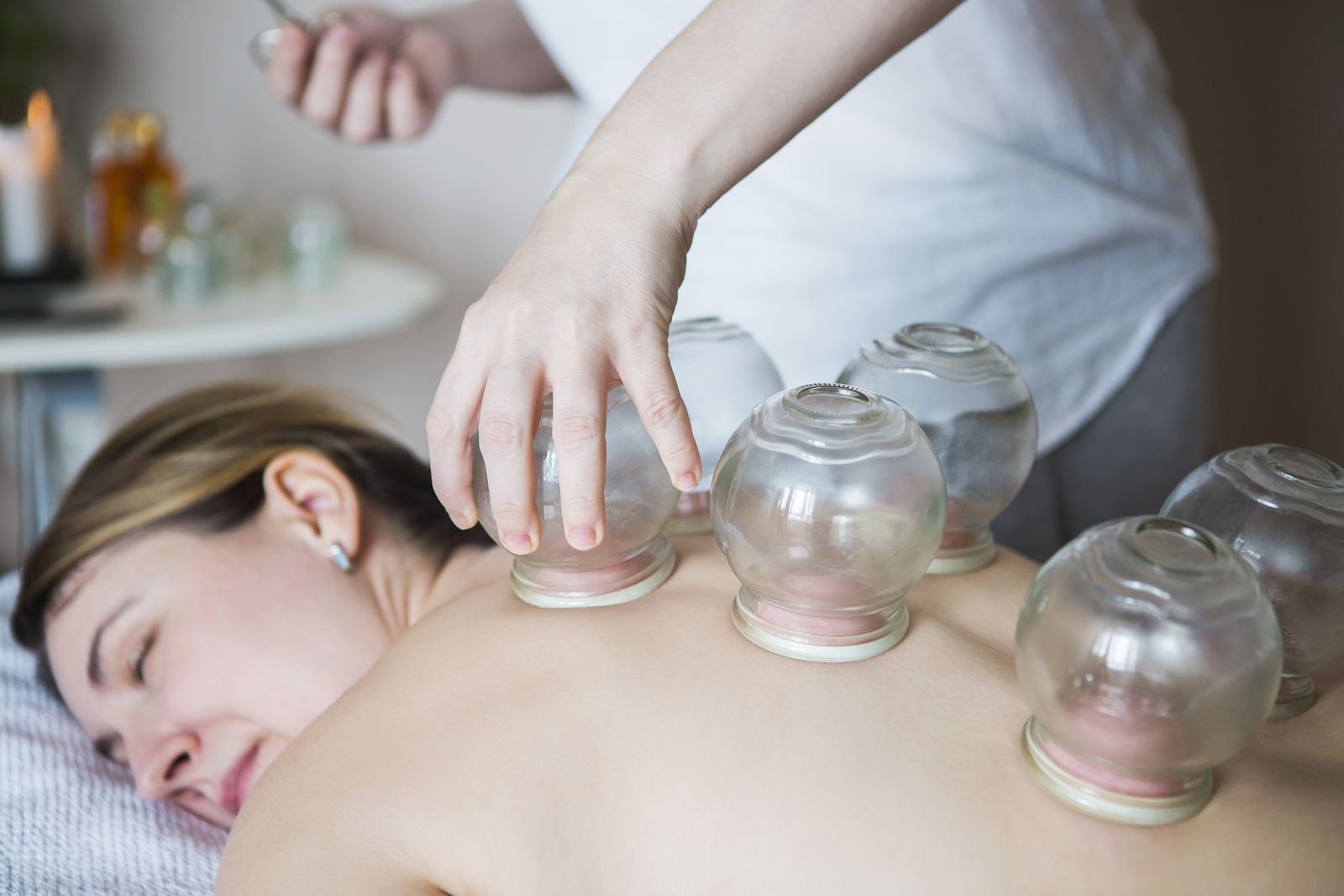Cupping Therapy treatment at New Ray Physiotherapy and Health Clinic in Abbotsford