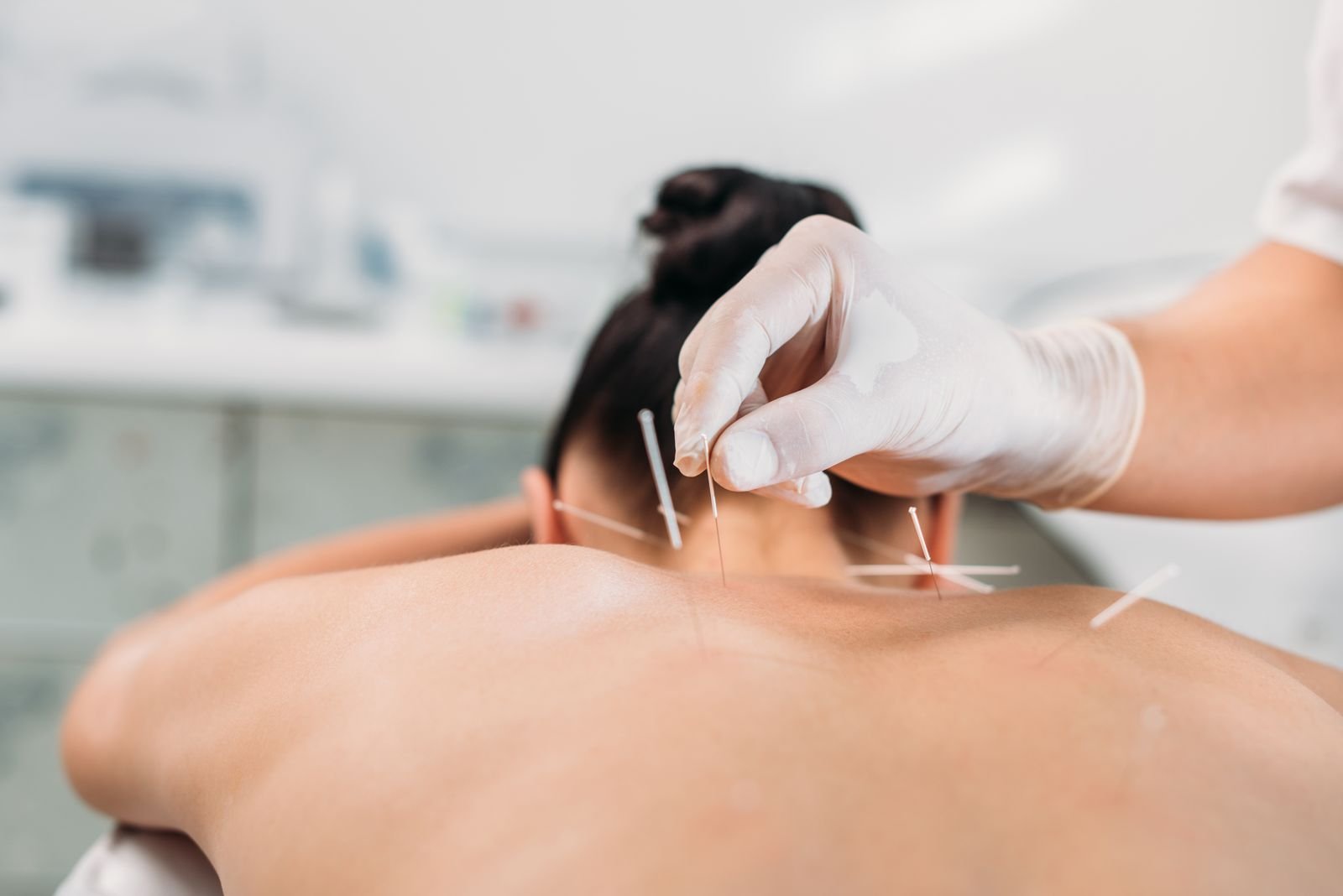 Acupuncture at New Ray Physiotherapy and Health Clinic in Abbotsford