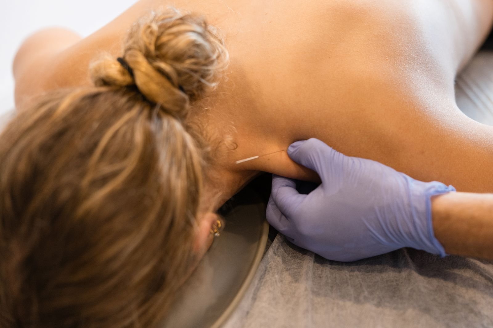 IMS & Dry Needling at New Ray Physiotherapy and Health Clinic in Abbotsford