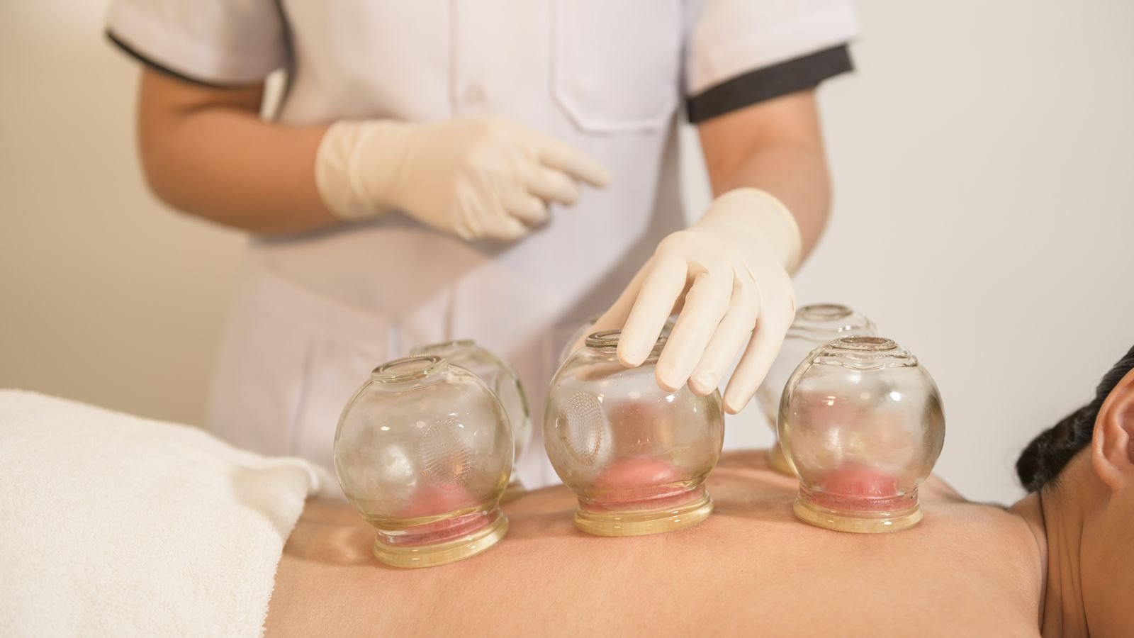 Cupping Therapy at New Ray Physiotherapy and Health Clinic in Abbotsford