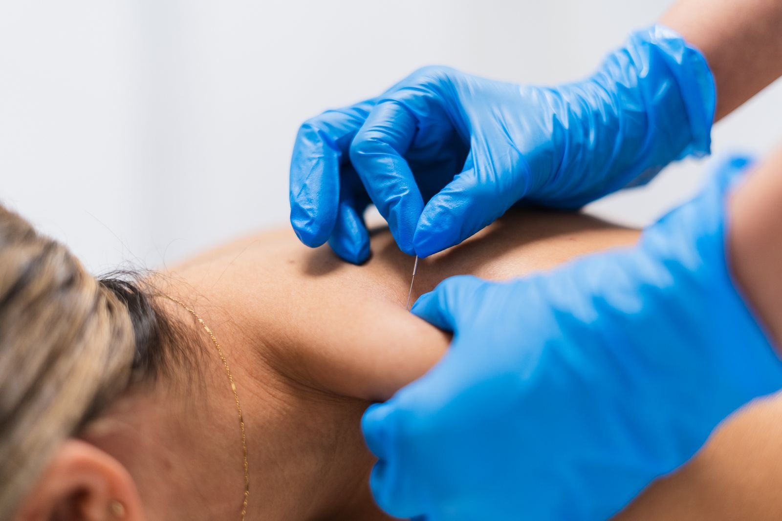 Acupuncture at New Ray Physiotherapy and Health Clinic in Abbotsford