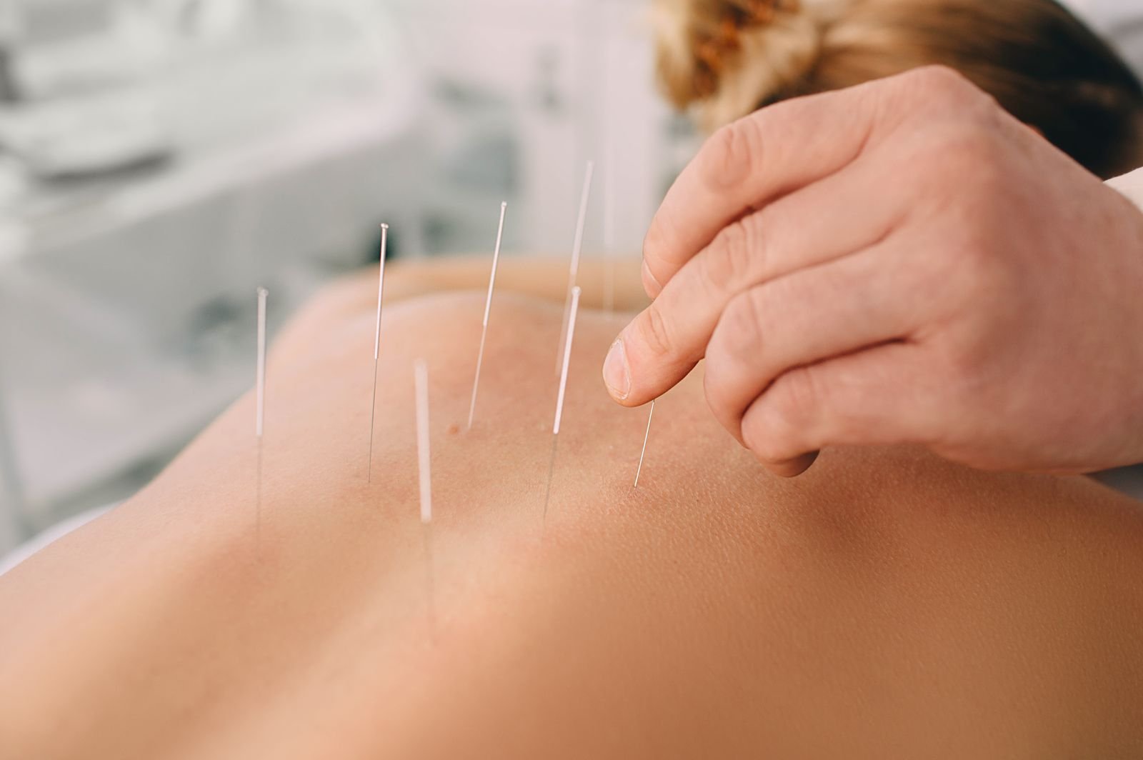 Acupuncture at New Ray Physiotherapy and Health Clinic in Abbotsford