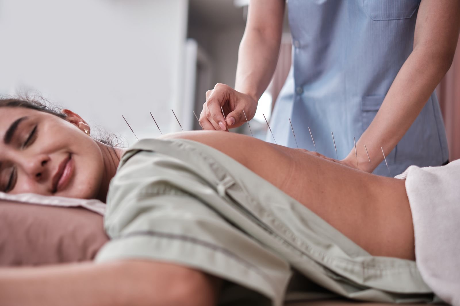 Acupuncture needles placed along a patient’s back